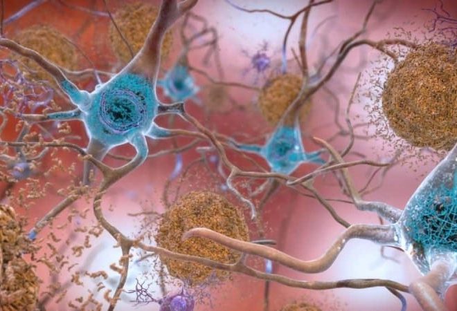 alzheimer