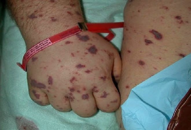 Meningite-Meningocócica-–-1