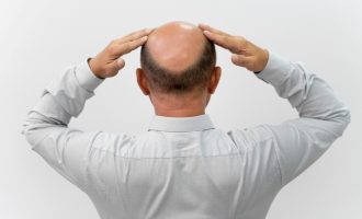 Veradermics_apresenta_resultados_robustos_de_medicamento_oral_contra_calvcie