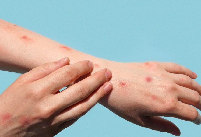 monkeypox variola macaco