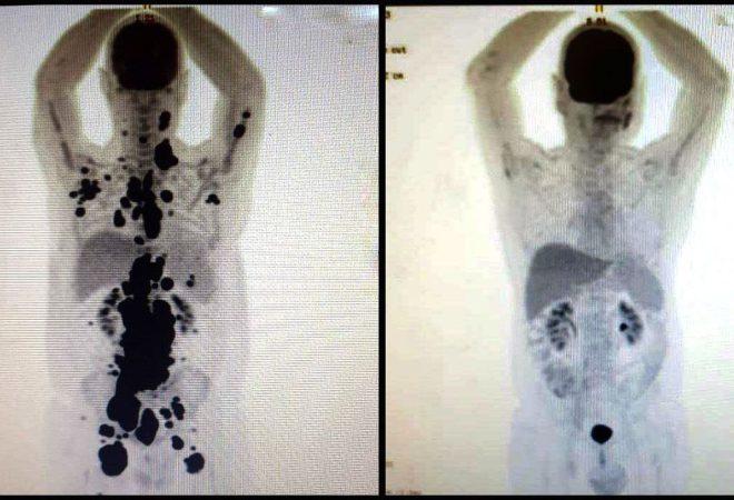 São Paulo (SP) - Com a terapia celular CAR-T Cell, o paciente Paulo Peregrino, 61 anos, teve remissão completa de um linfoma em apenas um mês. Foto: Arquivo pessoal