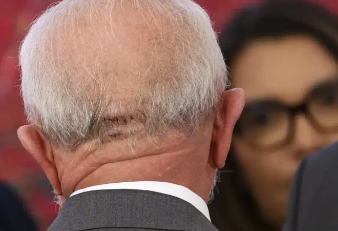 lula cabeça cirurgia foto marcelo camargo agencia brasil