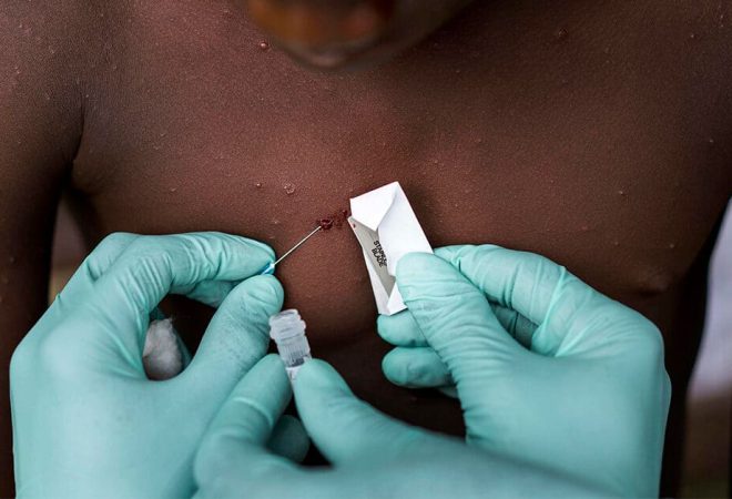 Being examined by Congolese doctors, a Manfuette village teenage boy is suspected of suffering from the MonkeyPox virus in Manfuette, Republic of Congo Tuesday August 29, 2017. The Washington Post/Getty Images