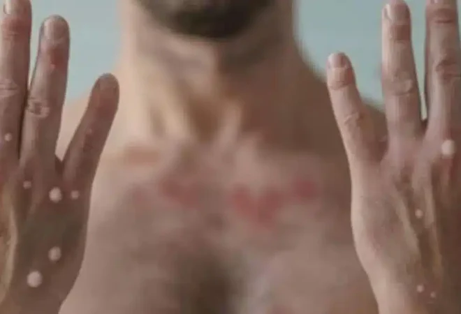 mpox