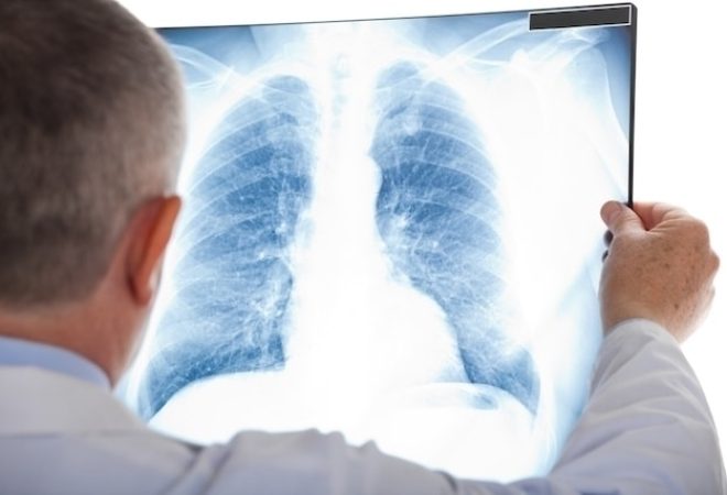 sindrome-respiratoria-aguda_30738_l