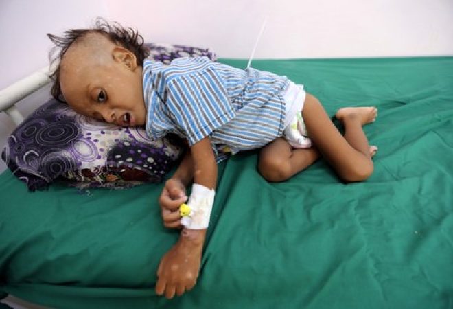 Menino de 2 anos em leito de hospital de Hodeidah, no Iêmen